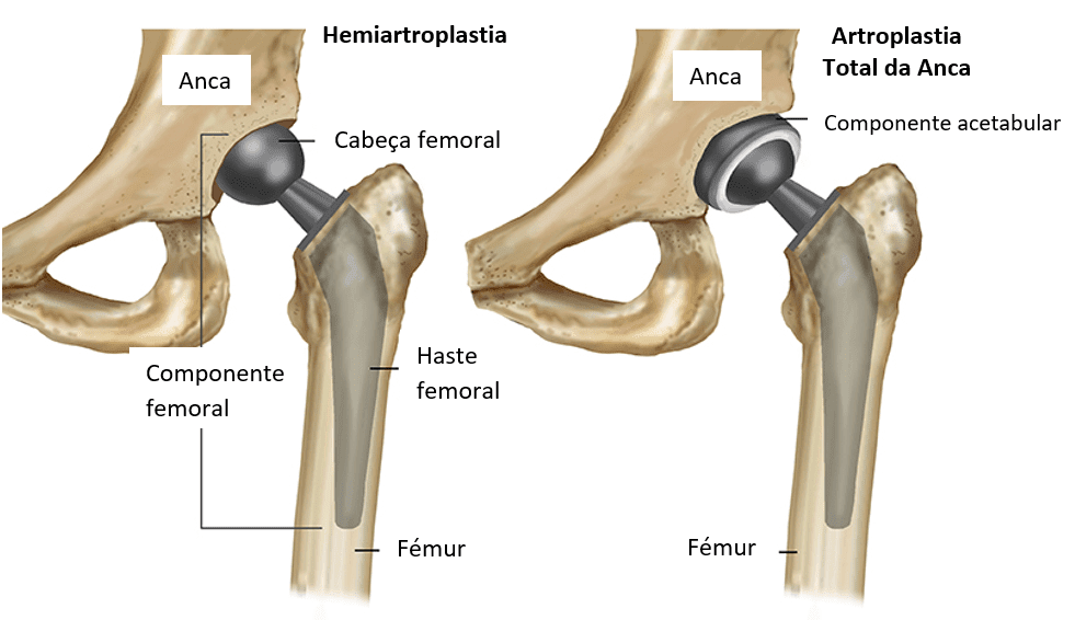 Artroplastia de Quadril Centro Ortopédico Centro Ortopédico Grajaú